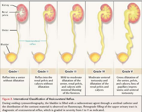 Endoscopic Treatment Of Primary Vesicoureteral Reflux Semantic Scholar