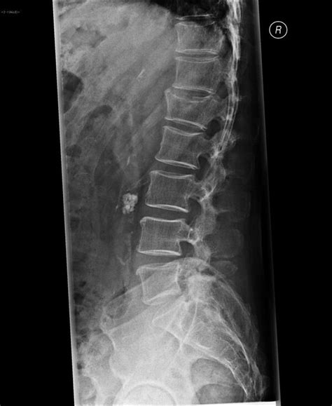 Compression Fracture Wikism Sports Medicine Wiki