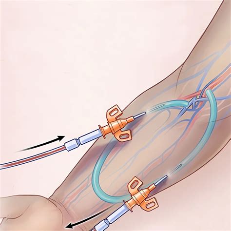Arteriovenous Fistula For Dialysis Venart Clinic