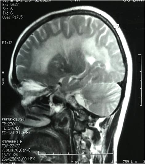 MRI brain contrast T2W with sagittal section showing hyperintensity... | Download Scientific Diagram