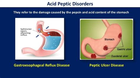 Basics Of Gerd Peptic Ulcer And Gastroparesis