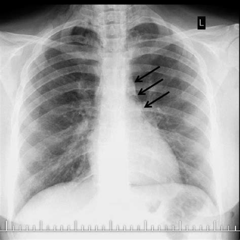 Anteroposterior Chest Radiograph The Lungs Are Clear And There Is Air