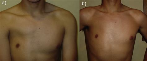 Laparoscopically Harvested Omental Flap For Breast Reconstruction In Poland Syndrome Journal