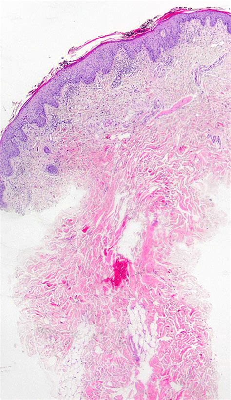 Epidermis shows slightly regular acanthosis and mild spongiosis (×40 ...