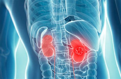 Role Of Stereotactic Ablative Body Radiotherapy In Kidney Cancer