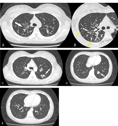 Figure From Cystic Fibrosis With Multiple Pulmonary Arteriovenous