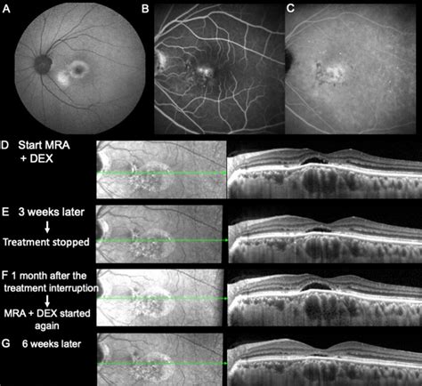 Multimodal Imaging Of The Left Eye Le Of A Year Old Male A