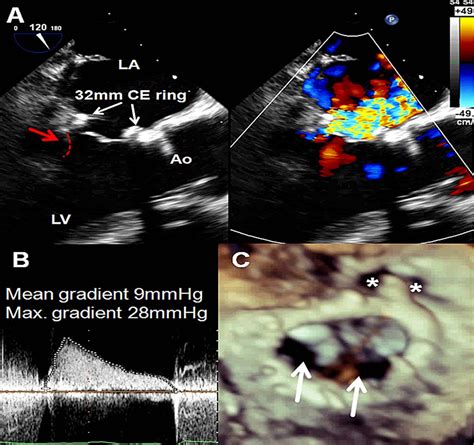 Figure 1 From Transcatheter Valve In Ring Implantation After A Failed