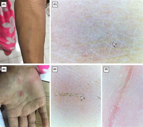 A And B Clinically Erythematous Maculopapular Rash Can Be Seen Over Download Scientific