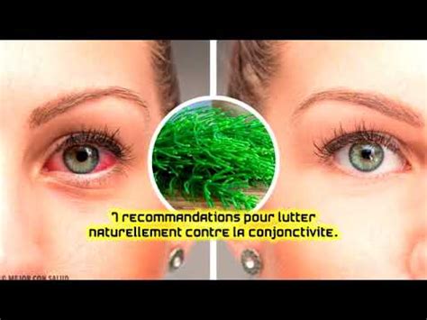 Recommandations Pour Lutter Naturellement Contre La Conjonctivite