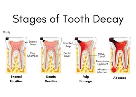 How to Heal Small Cavities at Home - Take Home Smile