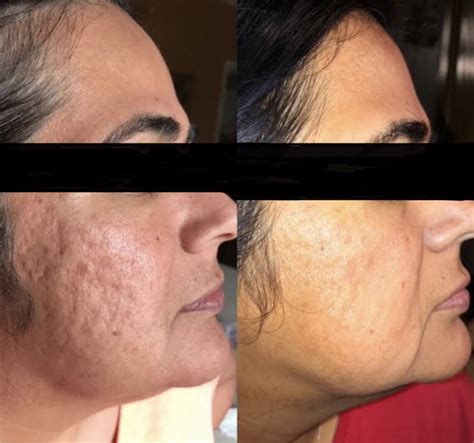 Undeniable Results With The Co2 Laser Before And After