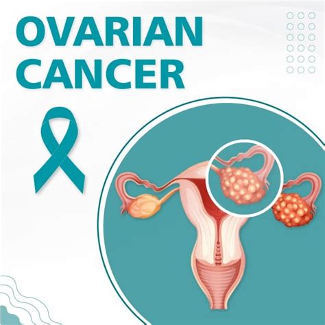 Ovarian Cancer, Signs and Symptoms | Uhapo