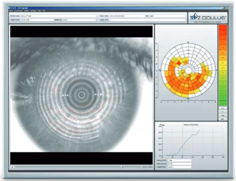 Lipiflow Dry Eye Treatment Faq In2eyes Optometry