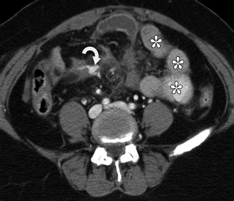 Evaluation Of Bowel And Mesenteric Blunt Trauma With Multidetector CT