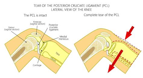 PCL Injury Treatment Chillicothe, OH - PCL Injury Reconstruction