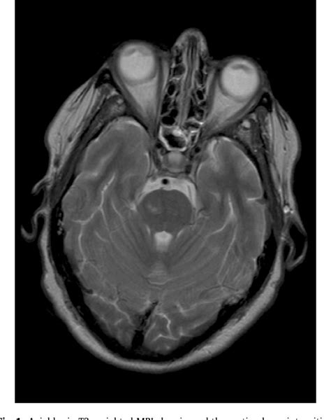 Figure 1 From A Modern Perspective On The Differential Diagnosis Between Encephalitis Lethargica