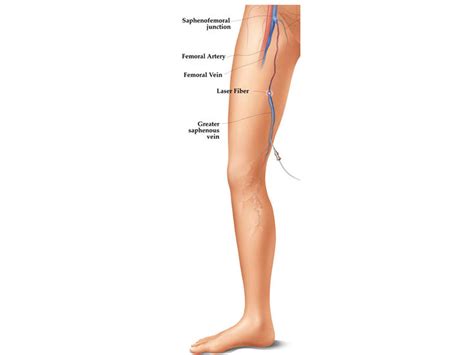 Laser Ablation Treatment | Fairfax Vascular Center