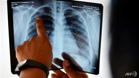 Commentary Why Are There Tuberculosis Cases In Singapore When Most