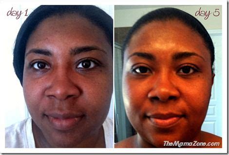 Makari Before & After - [Top Genuine Results ]- OBS - Cosmetic Blog