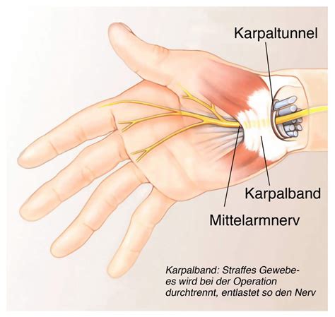 Karpaltunnelsyndrom Berblick Ratgeber Nerven