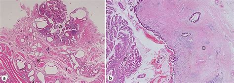 Histological Findings A Meckel Diverticulum A And Ectopic Pancreatic