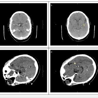 A B CT Brain Without Contrast Showing Multiple Small Round