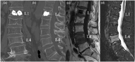 A B From The Preoperative Ct Three Dimensional Reconstruction Of The