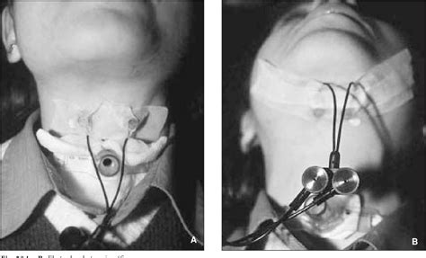 Pdf Fisioterapia Orofacial Y De Reeducaci N De La Degluci N Hacia