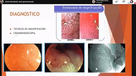 Gastroenterología ESOFAGO DE BARRET YouTube