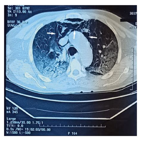 A B C Chest Ct Scan Showing Ground Glass Opacities With Crazy Download Scientific Diagram