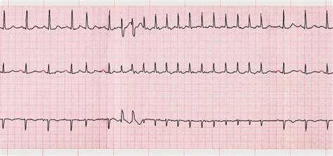 Atrial Fibrillation Overview Causes Symptoms Treatment Illness