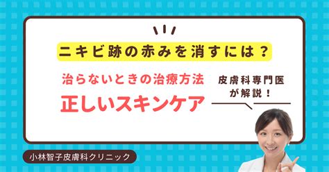 ニキビ跡の赤みを消すには？治らないときの治療方法やスキンケアまで皮膚科医が解説｜こばとも皮膚科｜栄駅（名古屋市栄区）徒歩2分