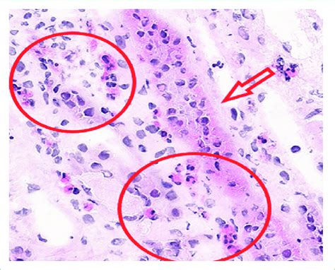 Muestra de anatomía patológica 1 Tinción de hematoxilina eosina