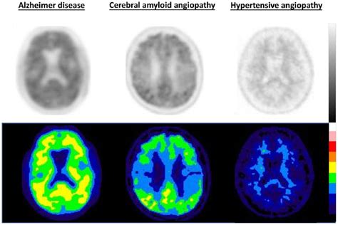 Advances In Cerebral Amyloid Angiopathy Imaging Szu Ju Chen Hsin Hsi