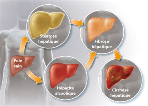 Toxicité De Lalcool Sur Le Foie Clinique Saint Amé