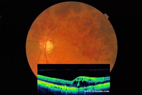 Branch Retinal Vein Occlusion