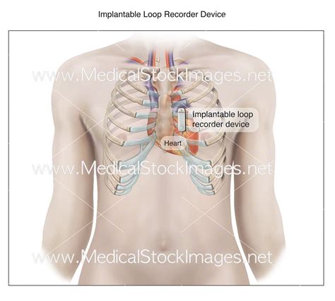 Medtronic Loop Recorder Removal