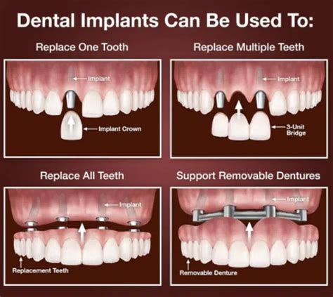 The Parts Of A Dental Implant Explained La Implants