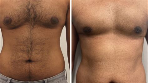 Gynecomastia And Male Chest Contouring With Vaser Liposuction And