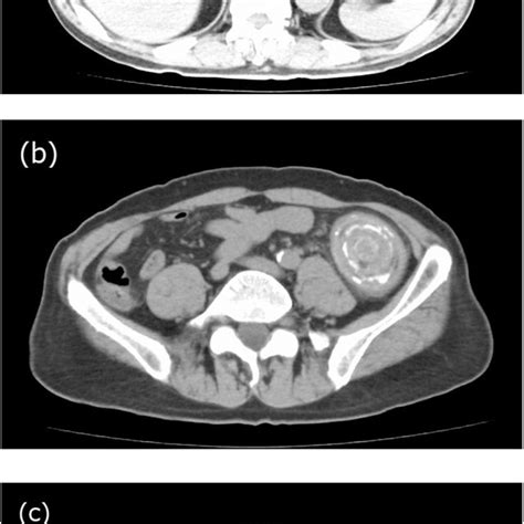 Surgical findings in a patient with gallstone ileus. A: An impacted ...