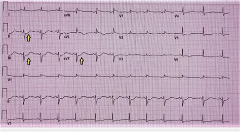 Ekg St Segment Depressions In Inferior Leads Ekg Electrocardiogram Download Scientific Diagram