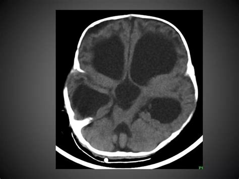 Hydrocephalus Case Presentation By Dr Abhijit R Singh Ppt