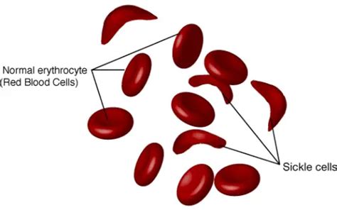 10 Interesting Sickle Cell Anemia Facts | My Interesting Facts