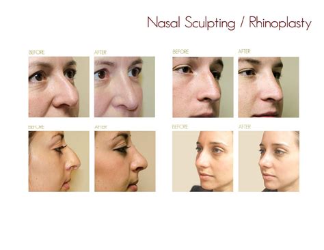 Rhinoplasty Drake And Presti Ent Surgical Associates