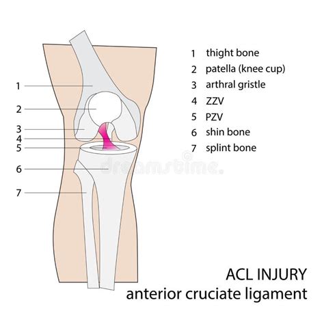 Acl knee injury stock vector. Illustration of ligament - 56900736