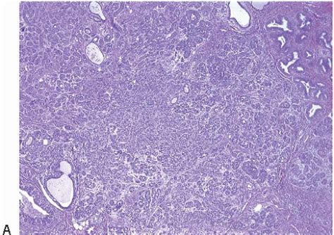 Adenosis And Sclerosing Lesions Oncohema Key