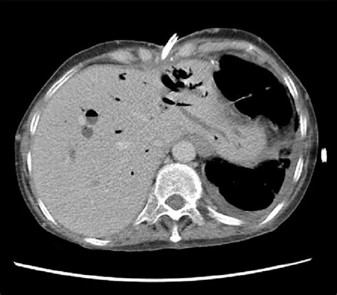 Ct Scan Showed Existing Percutaneous Biliary Drains Going Through A