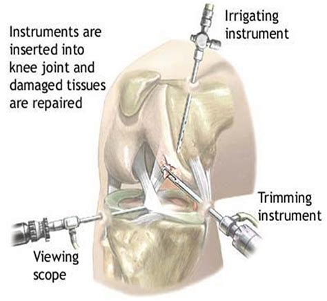 Arthroscopic Knee Surgery At The Most Affordable Costs With Indianmedtrip