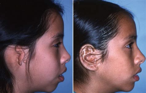 Facial birth deformities – Little Baby Face